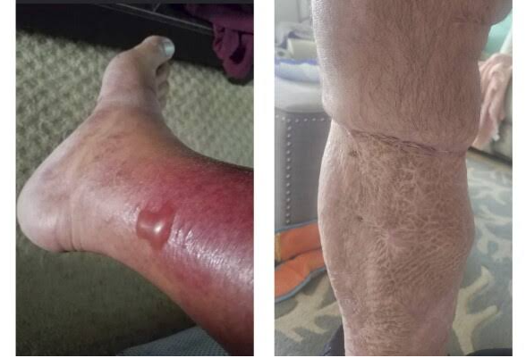Flesh-eating bacteria infections